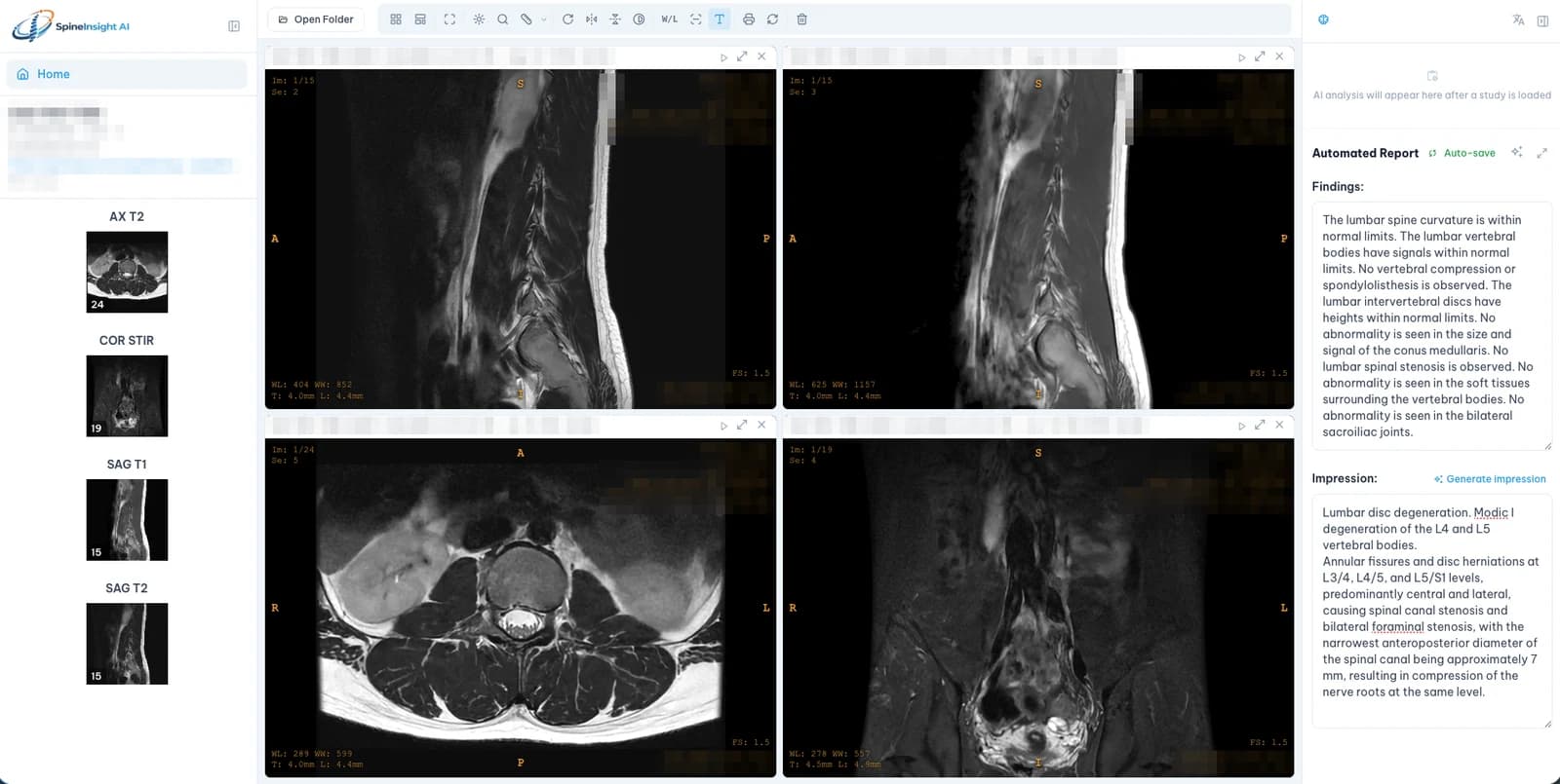 Giao diện SpineInsight AI: xem ảnh MRI cột sống và báo cáo tự động